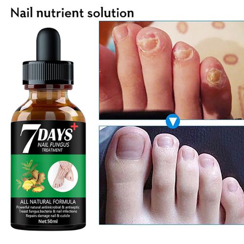 Natural oregano oil nail fungus repair serum